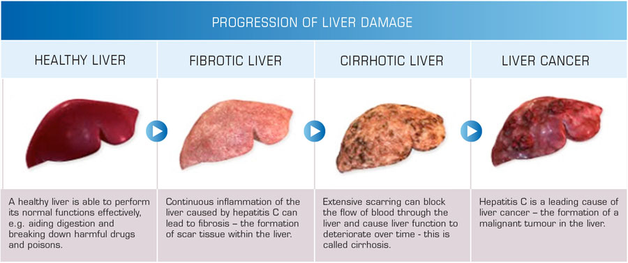 progression-of-liver-damage